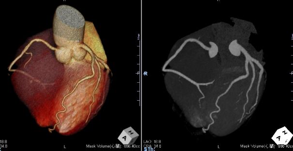 心臓CT写真