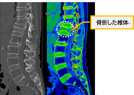 腰椎矢状断面