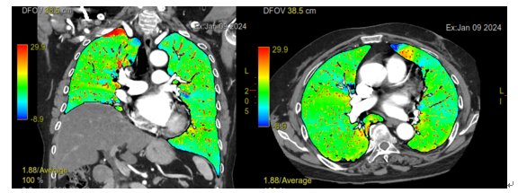 肺灌流カラーマップ画像